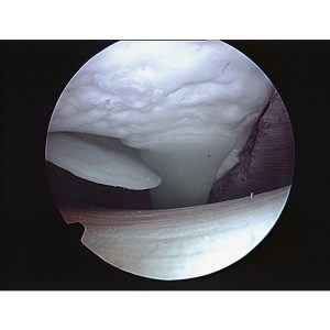 Arthroscopy Model of the Shoulder