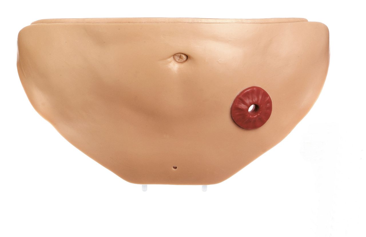 Abdominal Cavity Cover With Anus Praeter