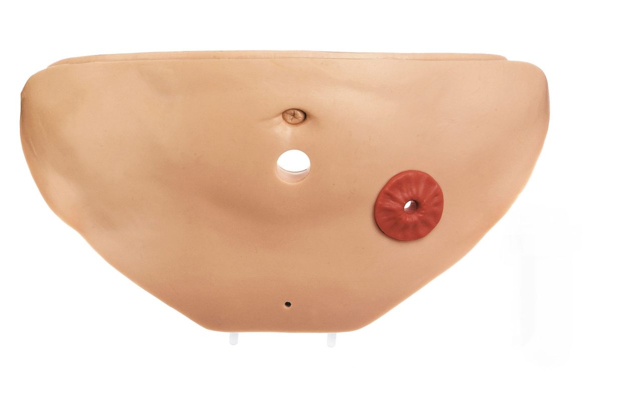 Stomach Wall With Anus Praeter and Insertion Aperture for the 2 Litre Bladder