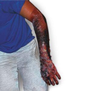 Simulated Burns (Set of 4)