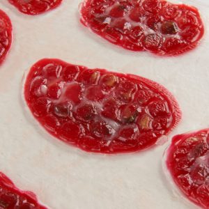 Venous Stasis Ulcer