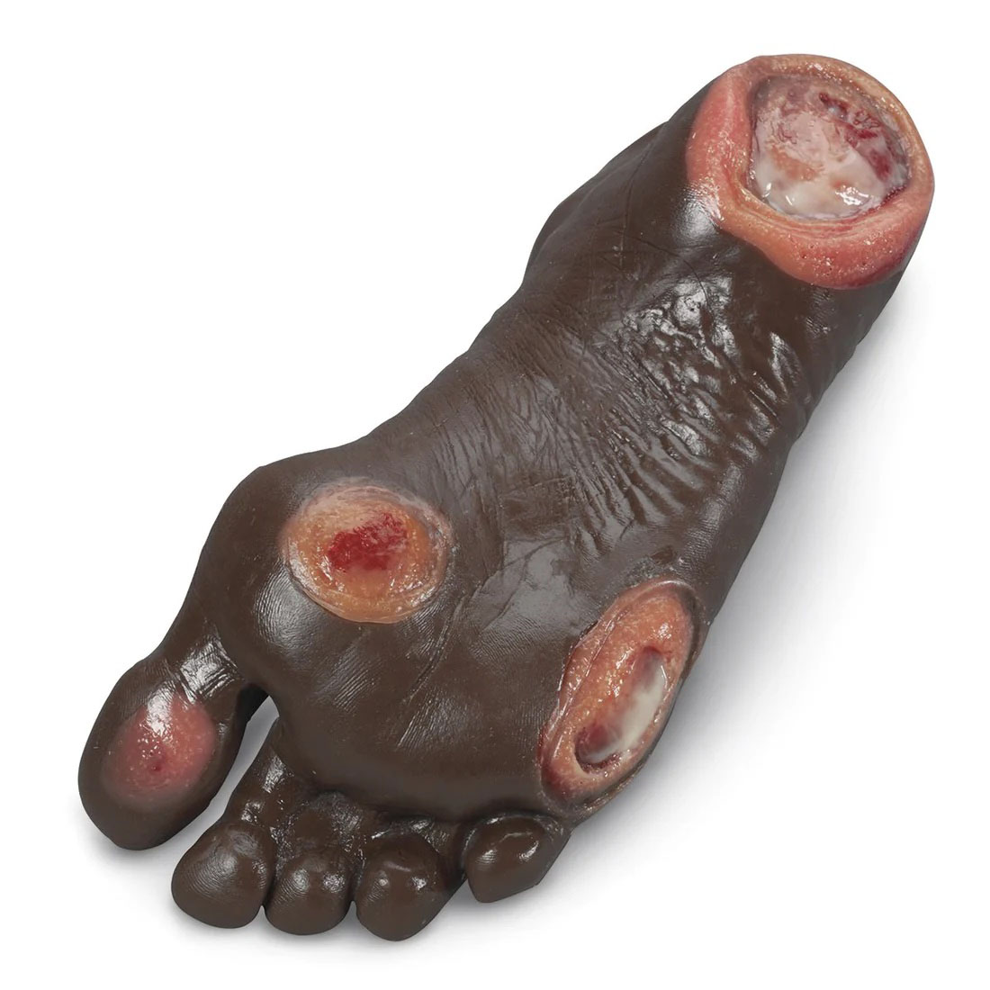 Elderly Pressure Ulcer Foot, Dark