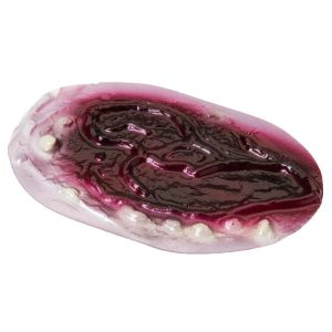 1st, 2nd and 3rd Degree Burn