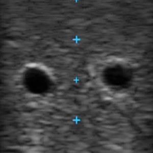 Vascular Access Ultrasound Phantom, Dark