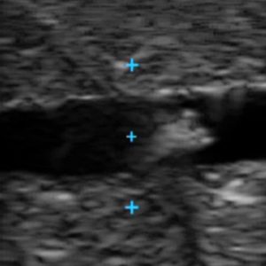 Vascular Access Ultrasound Phantom, Dark