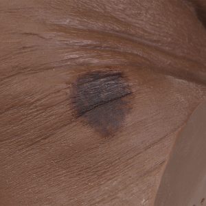 Seymour II Wound Care Model™, Dark