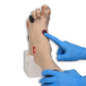 Wilma Wound Foot™, Light