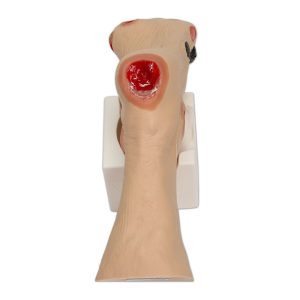 Wilma Wound Foot™, Light