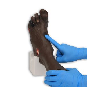 Wilma Wound Foot™, Dark
