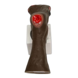 Wilma Wound Foot™, Dark