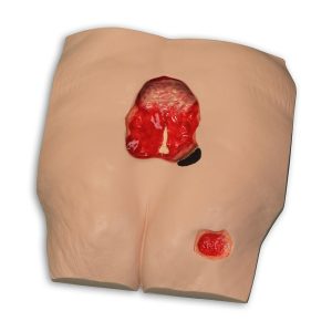 Stan™ Stage 4 Pressure Ulcer Model, Light