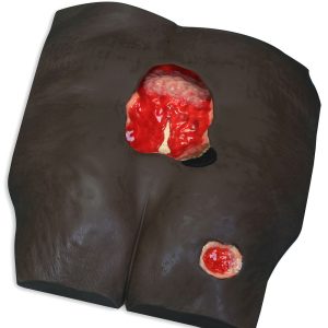Stan™ Stage 4 Pressure Ulcer Model, Dark
