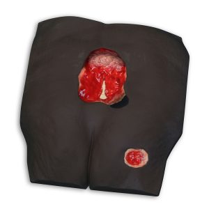 Stan™ Stage 4 Pressure Ulcer Model, Dark