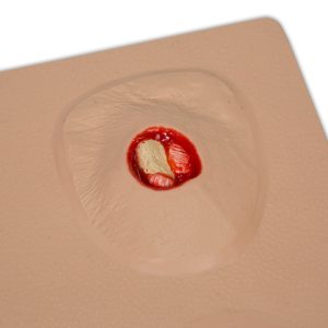 Pat Pressure Injury Staging Model™