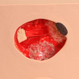 Pat Pressure Injury Staging Model™